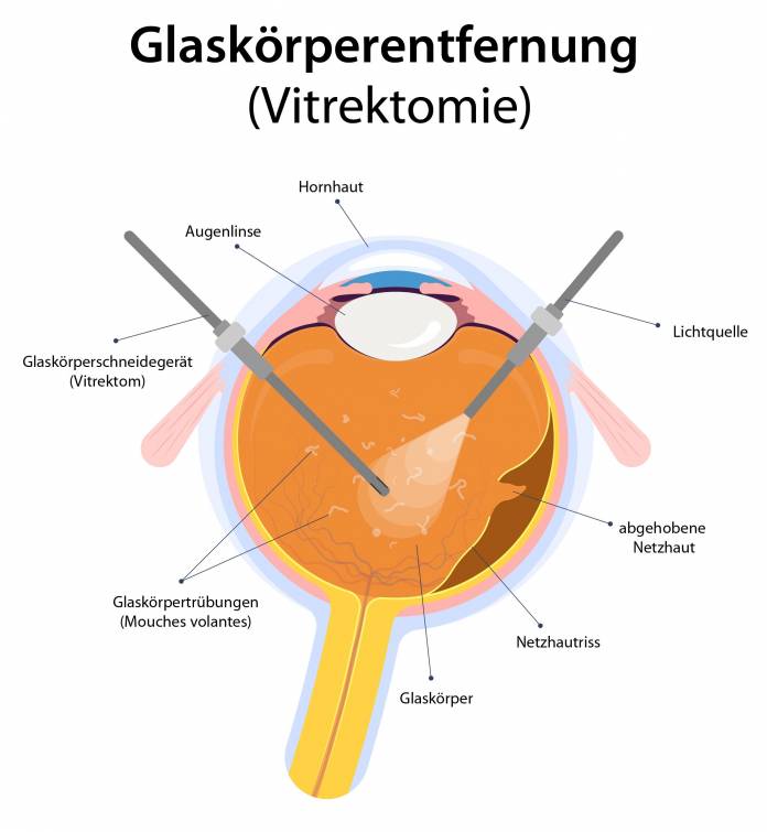 Glaskörperentfernung (Vitrektomie)