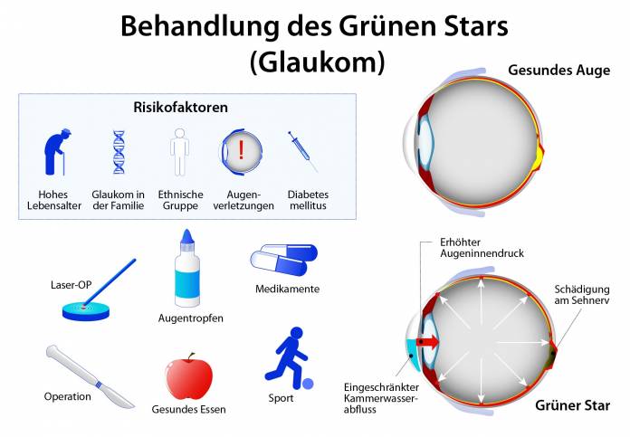 Behandlung des Grünen Stars (Glaukom)