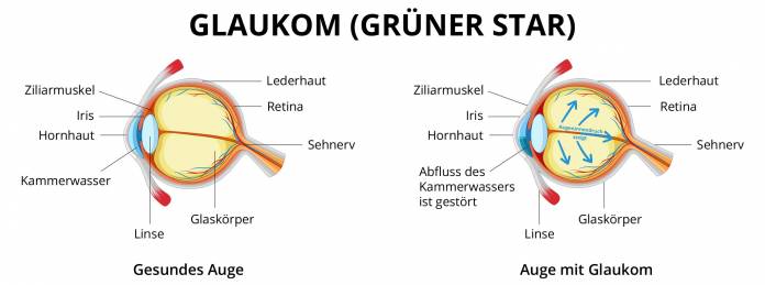 Grüner Star (Glaukom)