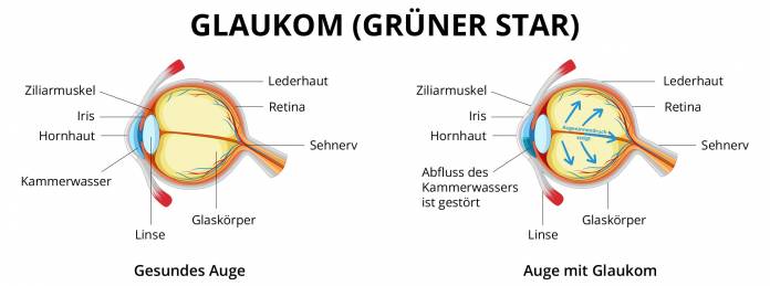 Glaukom (Grüner Star)