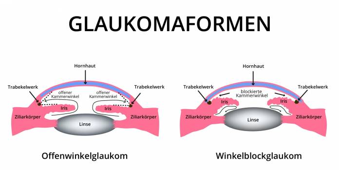 Glaukomaformen