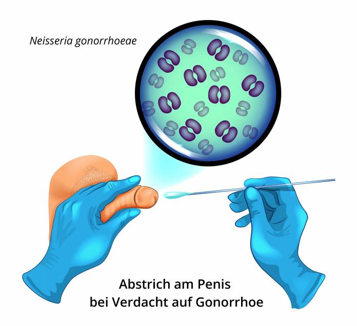 Abstrich am Penis bei Verdacht auf Gonorrhoe