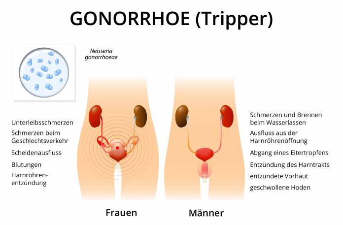 Tripper Symptome