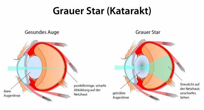 Grauer Star (Katarakt)
