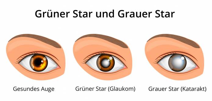 Unterscheidung Grüner Star und Grauer Star