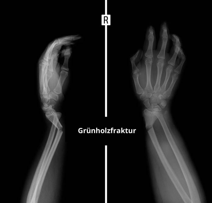 Röntgenbild einer Grünholzfraktur