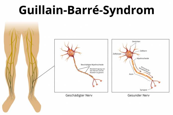 Guillain-Barré-Syndrom