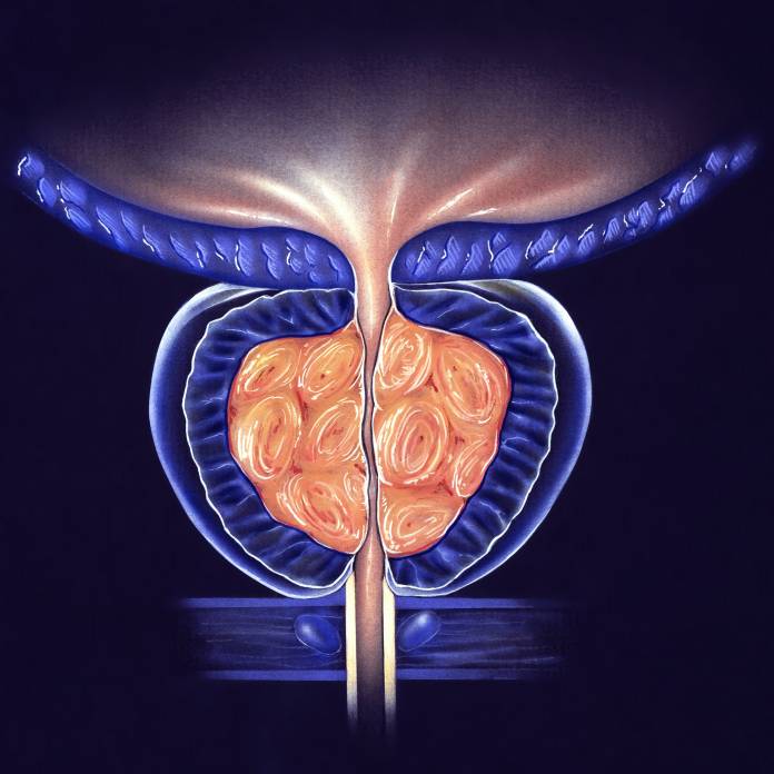 Gutartige Prostatavergrosserung Diagnose Op Ausschalung