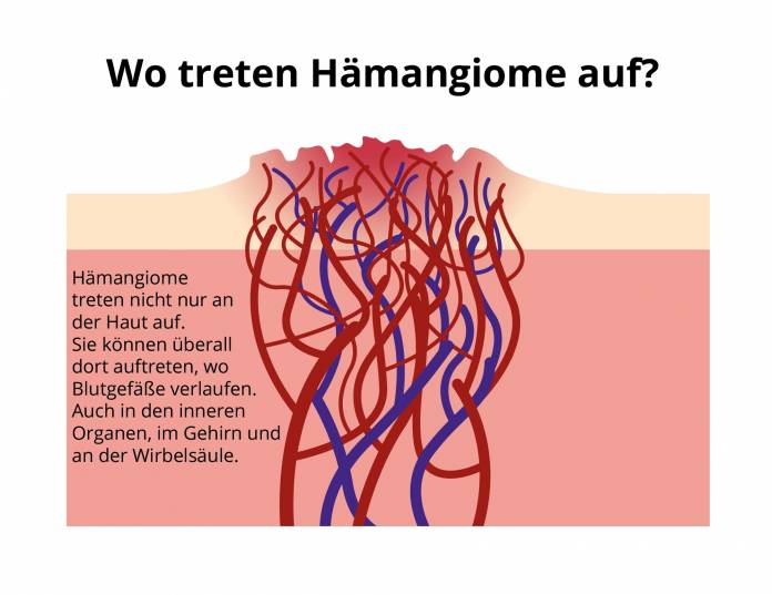 Wo treten Hämangiome auf?