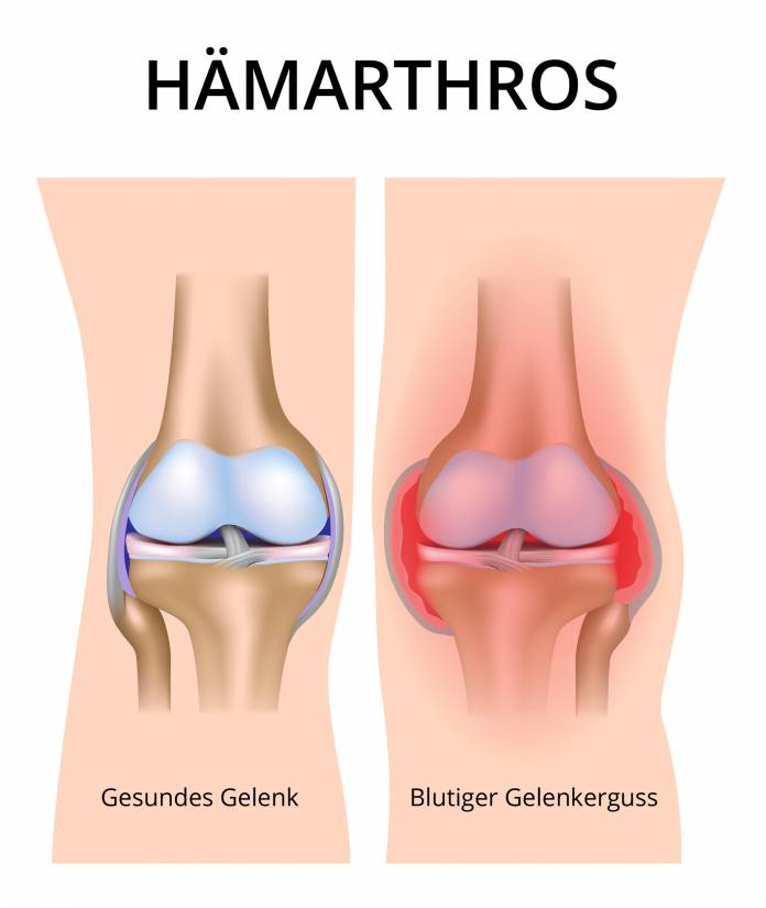 Hämarthros