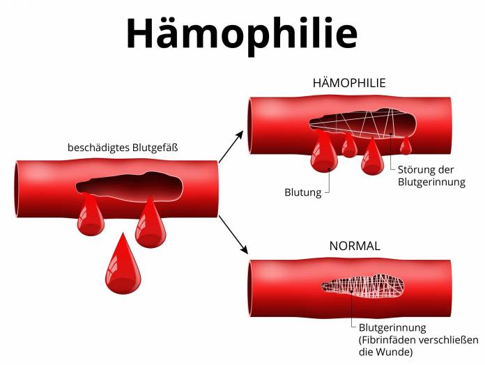 Hämophilie (Blutgerinnungsstörung)