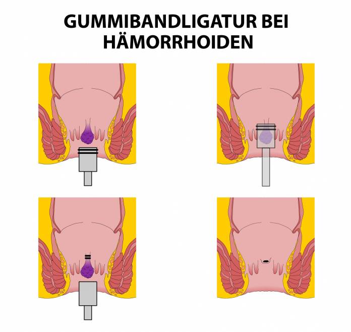 Gummibandligatur bei Hämorrhoiden