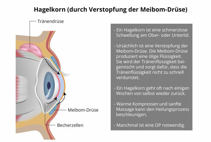 Hagelkorn Ursachen