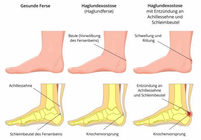 Haglundexostose (Haglundferse)