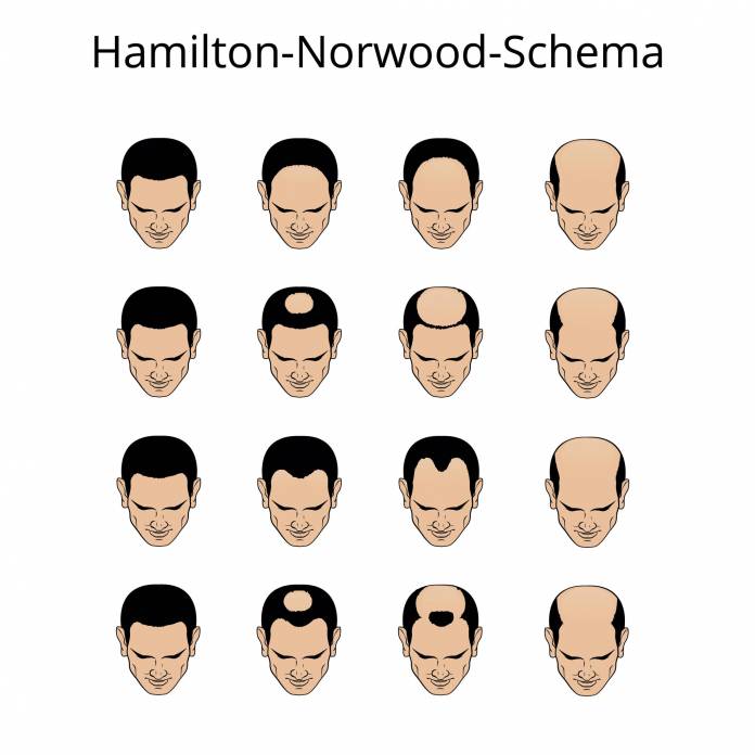 Hamilton-Norwood-Schema
