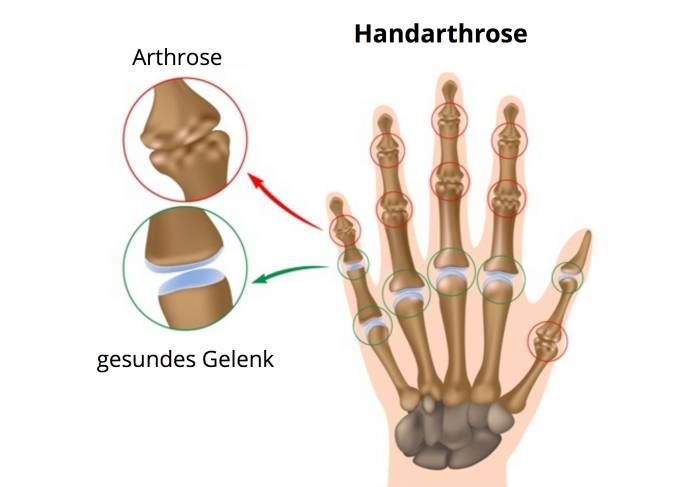 Handarthrose