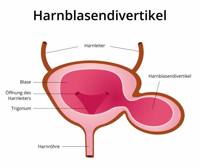 Harnblasendivertikel