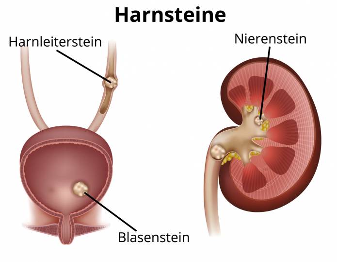 Harnsteine