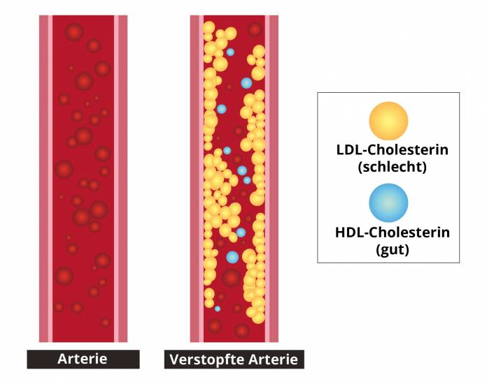 HDL-Cholesterin und LDL-Cholesterin