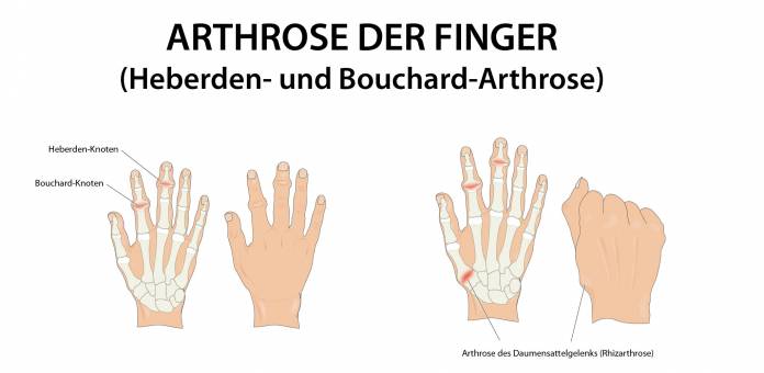 Arthrose in den Fingern (Heberden- und Bouchard-Arthrose)