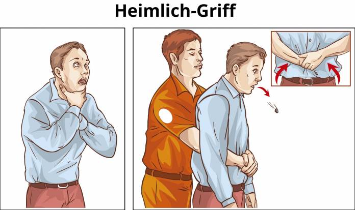 Heimlich-Griff