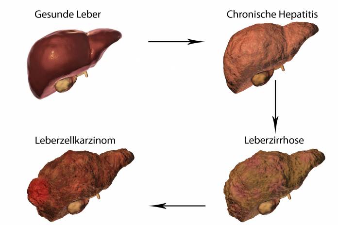 Verlauf Hepatitis