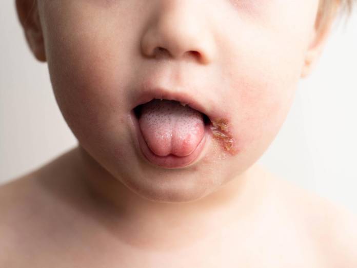 Herpes im Mund - wie kommt es dazu und wie wird behandelt? 