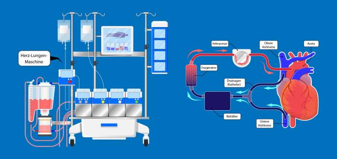 Aufbau einer Herz-Lungen-Maschine