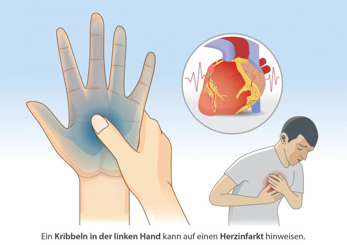 Kribbeln in der linken Hand - Herzinfarkt