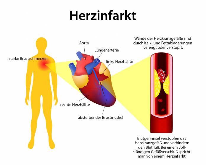 Herzinfarkt