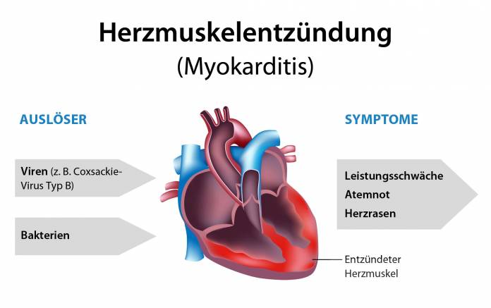 Herzmuskelentzündung (Myokarditis)