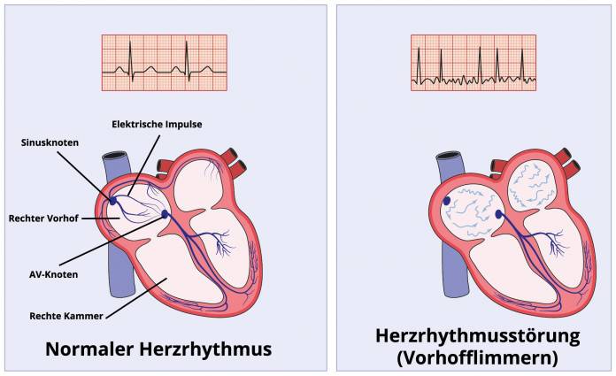 Herzrhythmusst rungen  Arrythmie Bradykardie Tachykardie