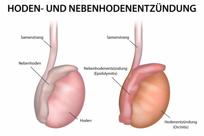 Hoden- und Nebenhodenentzündung