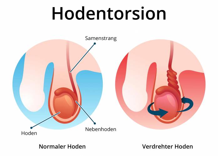 Hodentorsion