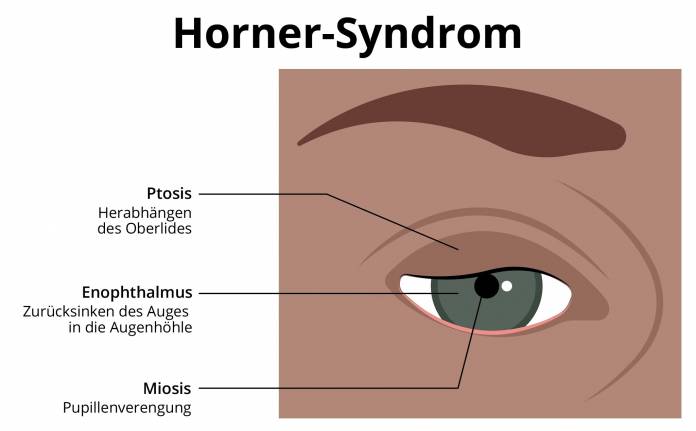 Horner-Syndrom