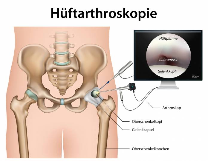 Hüftarthroskopie bei einem Labrumriss