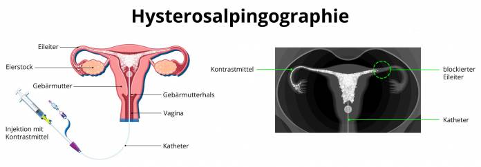 Hysterosalpingographie