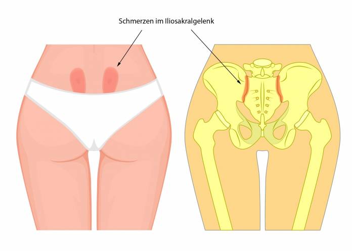 Schmerzen im Iliosakralgelenk (ISG)