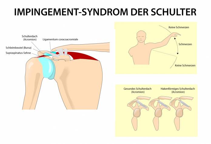 Impingement-Syndrom der Schulter