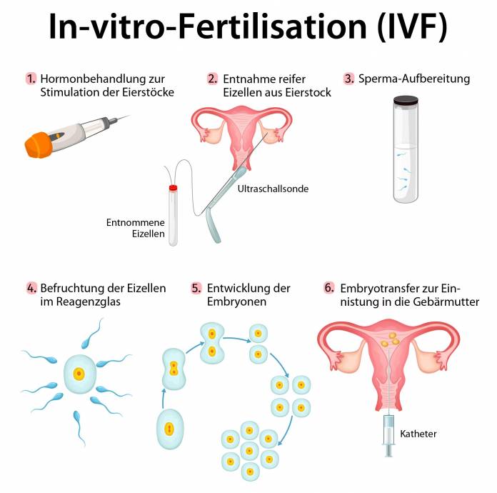 In-Vitro-Fertilisation (IVF)