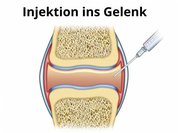 Injektion in das Gelenk