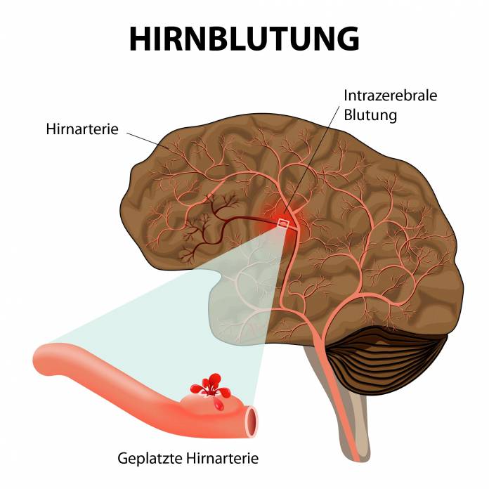 Intrazerebrale Hirnblutung