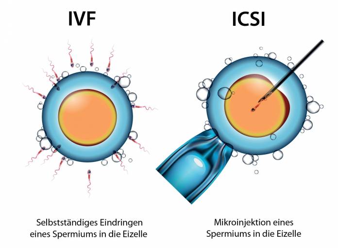 Gegenüberstellung von IVF und ICSI