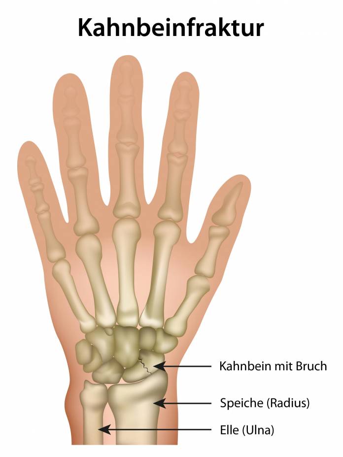 Kahnbeinbruch