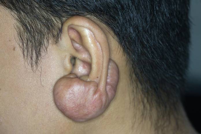 Am penis narbe How Big