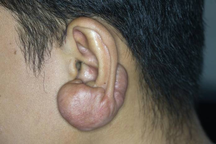 Keloid am Ohr