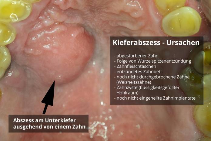 Kieferabszess - Ursachen