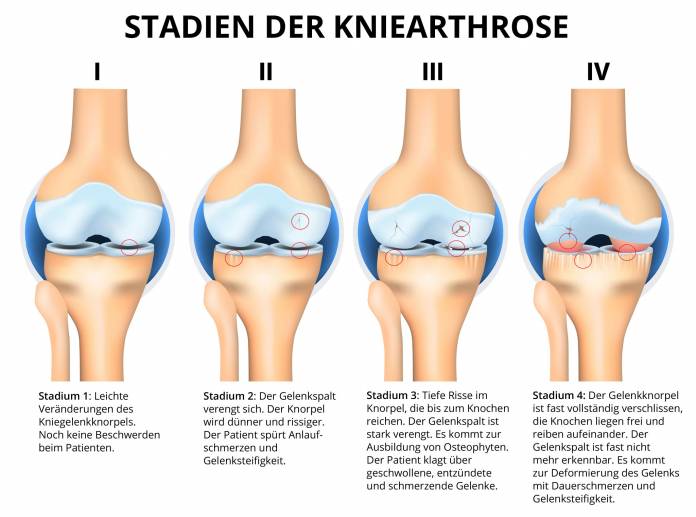 Stadien der Kniearthrose
