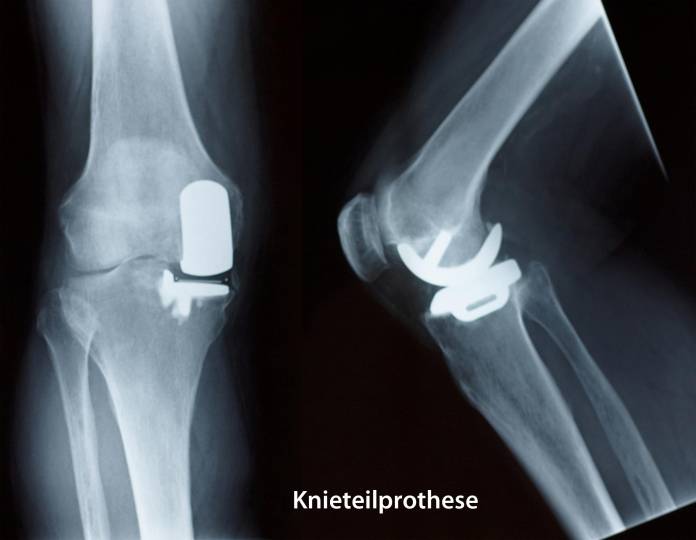 Schlittenprothese (Knieteilprothese)