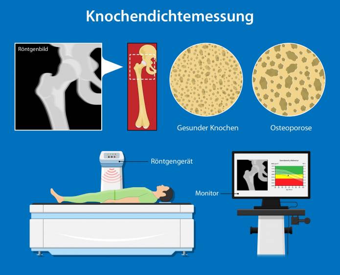 Knochendichtemessung